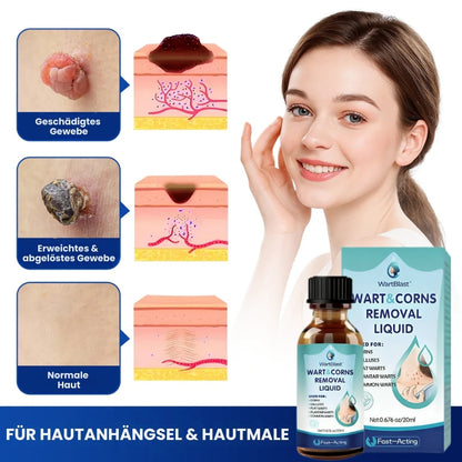 WartBlast™ | Warzen- und Hühneraugen-Entfernungsflüssigkeit