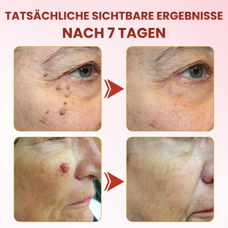 TagGone™ | Schmerzfreie Hautanhängsel-Entfernung mit MicroDart-Pflastern