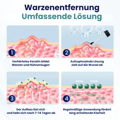 WartBlast™ | Warzen- und Hühneraugen-Entfernungsflüssigkeit