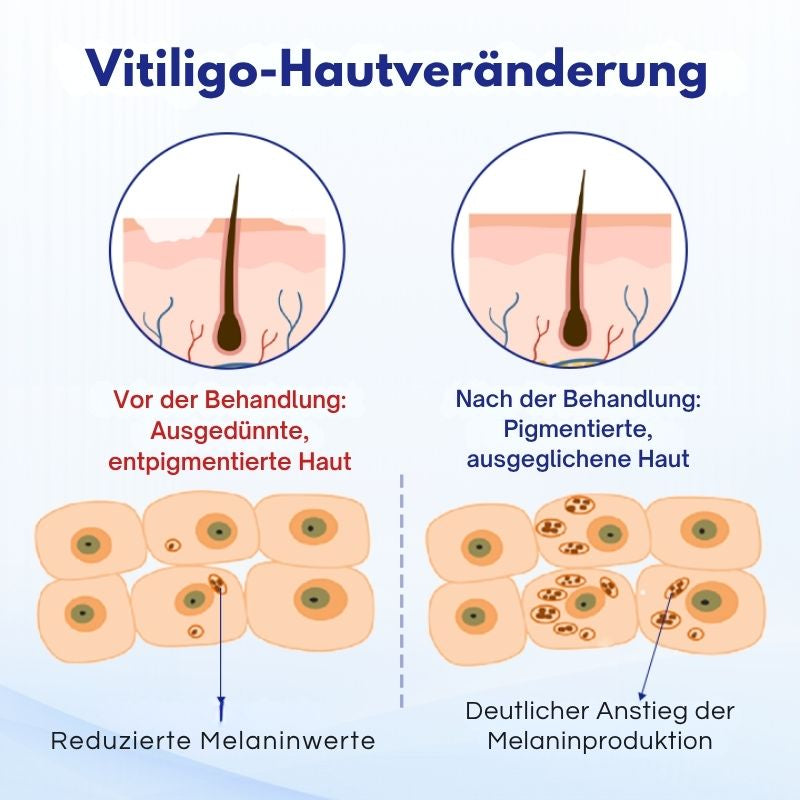 VitiClear™ | Unterstützt 3× schnellere Repigmentierung – sichtbare Ergebnisse in 2 Wochen!