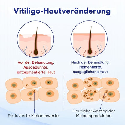 VitiClear™ | Unterstützt 3× schnellere Repigmentierung – sichtbare Ergebnisse in 2 Wochen!