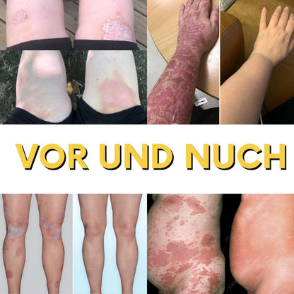 NaturDerm™ | Haut Beruhigende Kräutersalbe