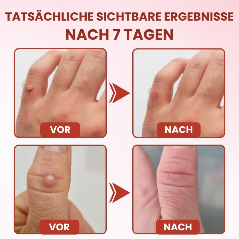 TagGone™ | Schmerzfreie Hautanhängsel-Entfernung mit MicroDart-Pflastern