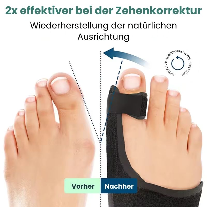 OrthoAlign™ | Sichtbare Korrektur bei Hallux Valgus bereits ab der ersten Anwendung!