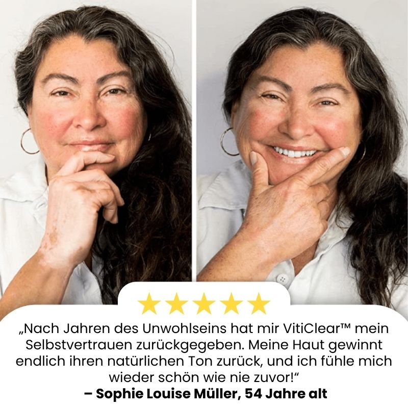 VitiClear™ | Bienengift Vitiligo Creme