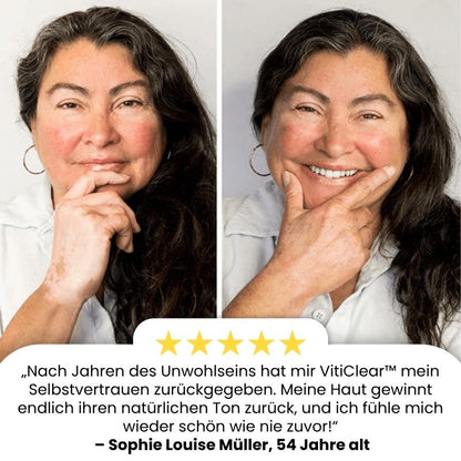 VitiClear™ | Bienengift Vitiligo Creme