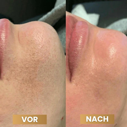 PeelShot™ | Fortschrittliches Poren-reinigendes Exfoliationssystem