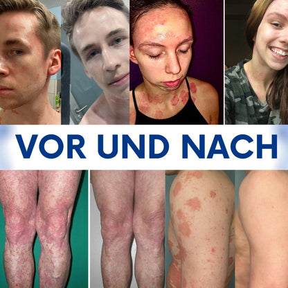 CuraSkin™ | Psoriasis- und Ekzem-Creme