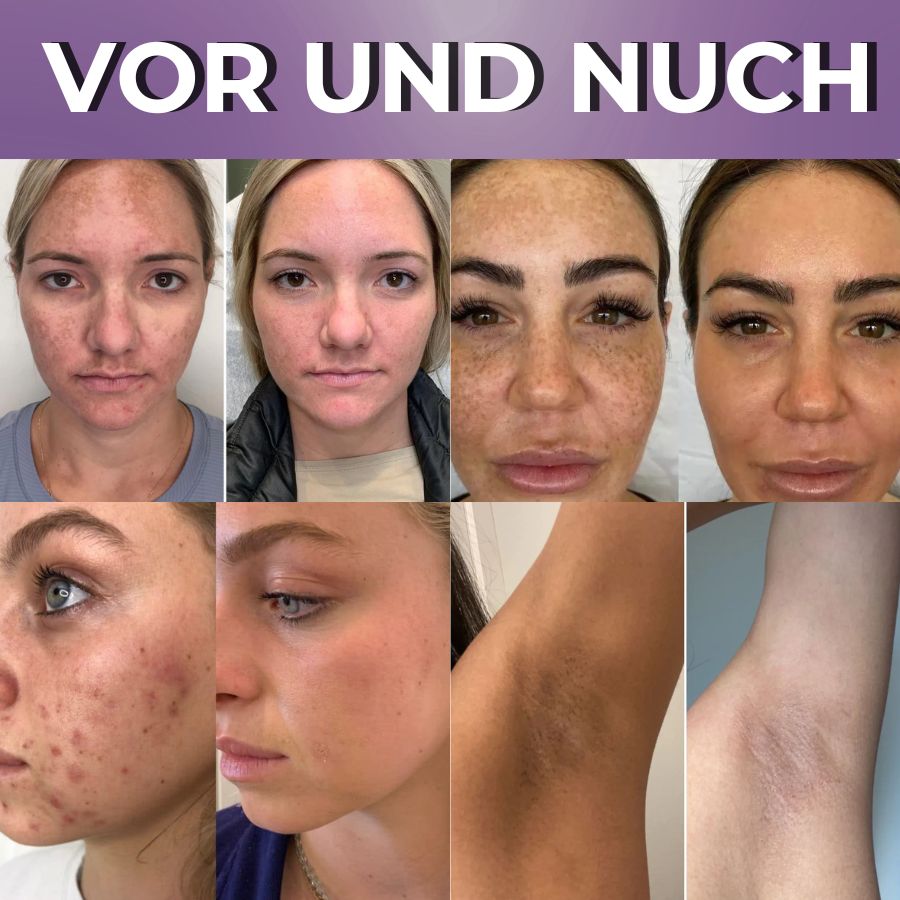 BrillaSkin™ | Fortschrittliche Anti-Hyperpigmentierungscreme