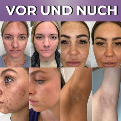 BrillaSkin™ | Fortschrittliche Anti-Hyperpigmentierungscreme