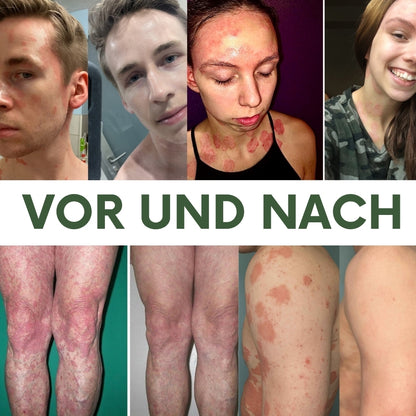 PsoriaCalm™ | Ekzem- und Psoriasis-Creme