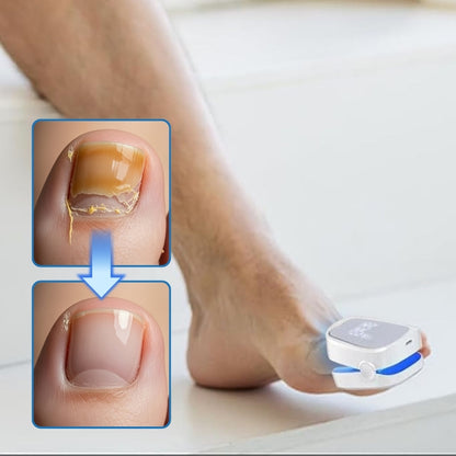 ClearNail Pro™ | Nagelpilz-Lasergerät