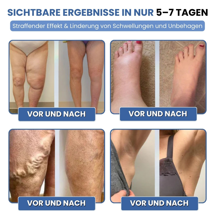 SwelEase™ | Kräutercreme zur Ödempflege