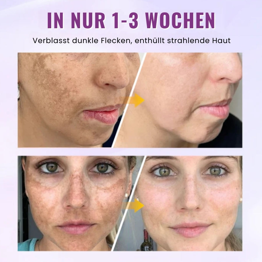 GlowGenix™ | Niacinamid Aufhellendes Sommersprossen Serum