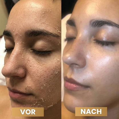 PeelShot™ | Fortschrittliches Poren-reinigendes Exfoliationssystem