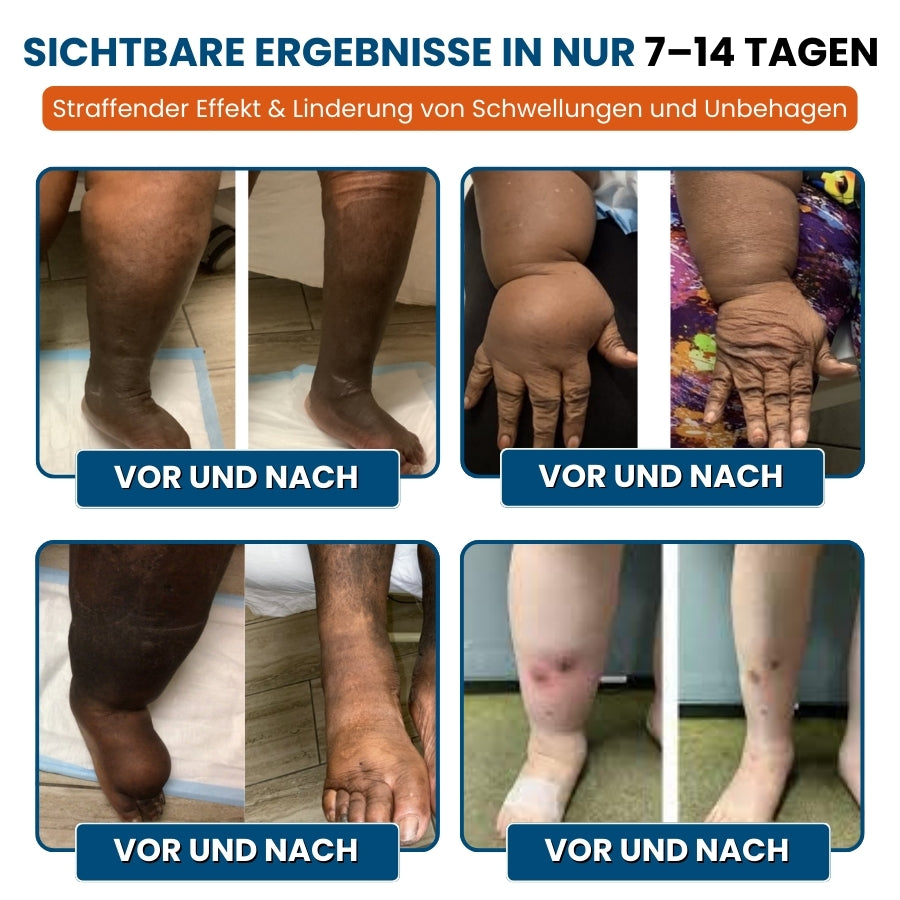 LymphoEase™ | Fühlen Sie sich in nur 14 Tagen leicht, entspannt und frei von Schwellungen