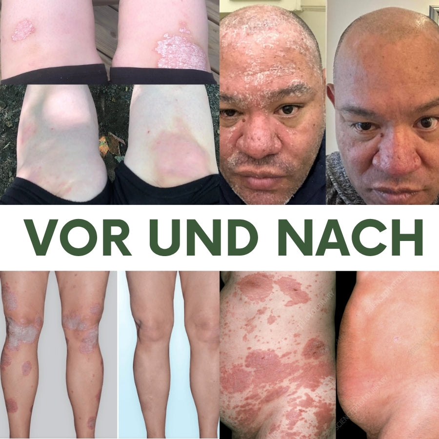 PsoriaCalm™ | Ekzem- und Psoriasis-Creme