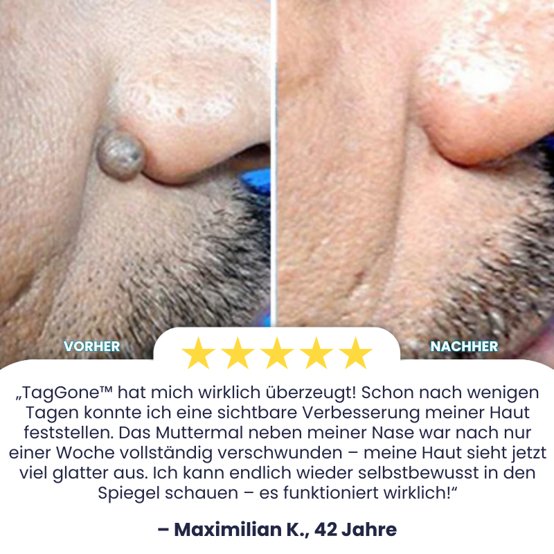 TagGone™ | Tags- und Muttermalentferner
