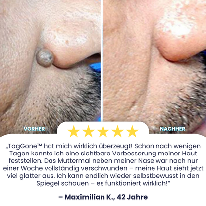 TagGone™ | Tags- und Muttermalentferner