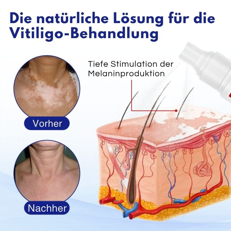 VitiClear™ | Unterstützt 3× schnellere Repigmentierung – sichtbare Ergebnisse in 2 Wochen!
