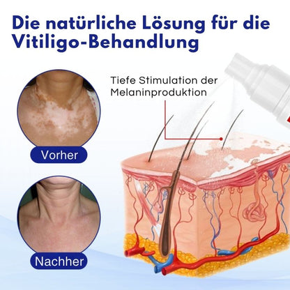 VitiClear™ | Unterstützt 3× schnellere Repigmentierung – sichtbare Ergebnisse in 2 Wochen!