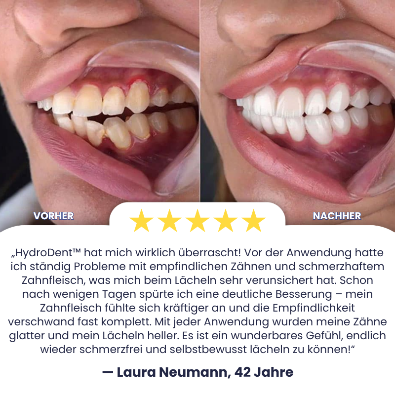 HydroDent™ | Beseitigt 97 % aller Karies und Zahnempfindlichkeit in nur 5 Tagen!