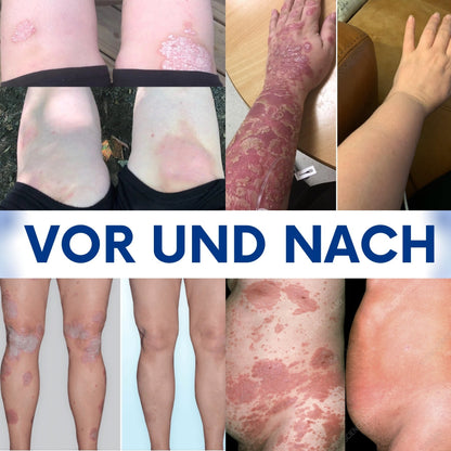 CuraSkin™ | Psoriasis- und Ekzem-Creme