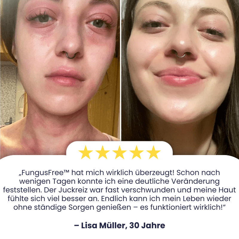 FungusFree™ | Antimykotische Creme