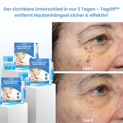 TagOff™ | Komplettset zur Entfernung von Hautanhängseln