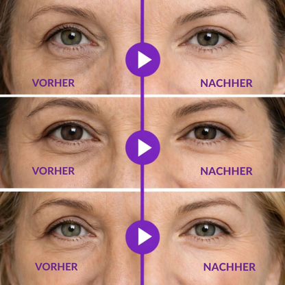 EyeLux™ | Mikronadel-Patches