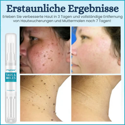 TagGone™ | Tags- und Muttermalentferner