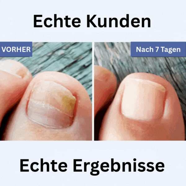 FungaClear™ Anti-Pilz-Stift
