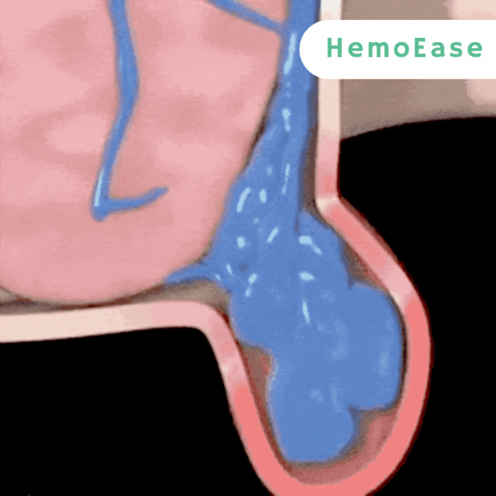 HemoEase™ Creme | Lindert 99 % der Hämorrhoidenschmerzen bereits bei der ersten Anwendung