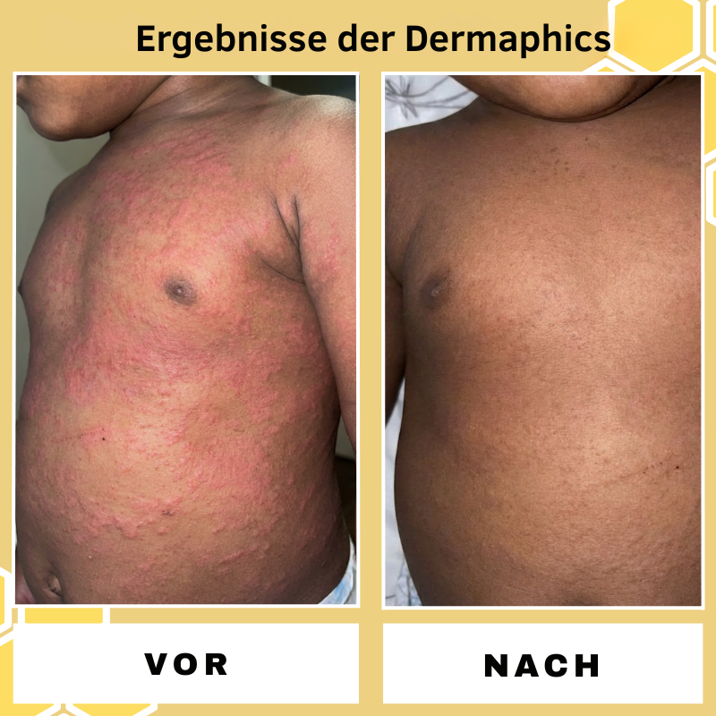 Dermaphics ™ Eczema Relief Cream