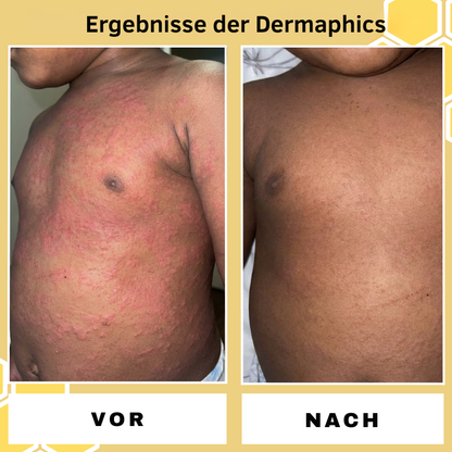 Dermaphics ™ Eczema Relief Cream