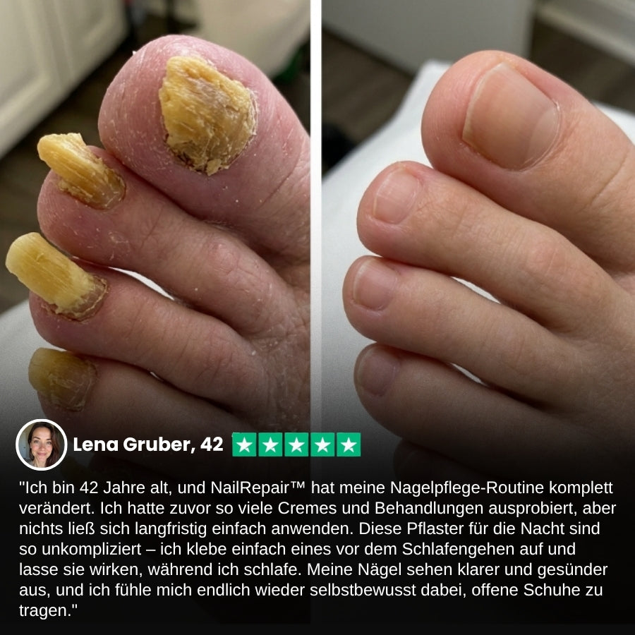NailRepair™ | Antimykotisches Nagelpflaster