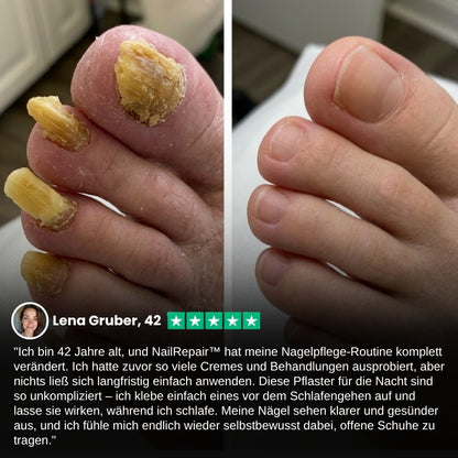 NailRepair™ | Antimykotisches Nagelpflaster