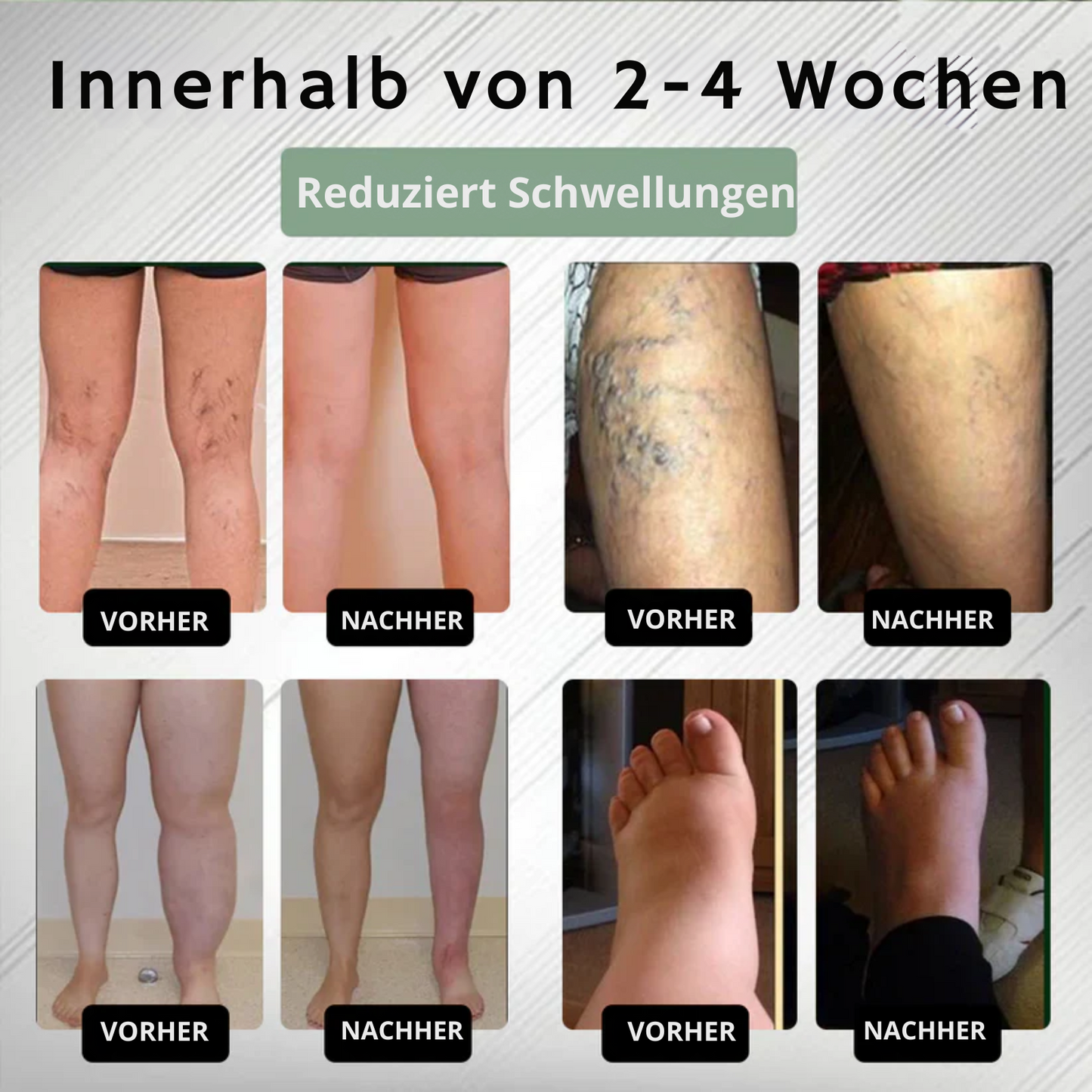 EdemaEase™ | Verabschiede dich noch heute von Schwellungen!
