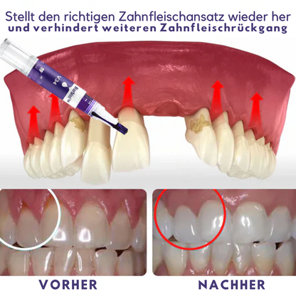 ZahnfleischVital™ | Baut zurückgehendes Zahnfleisch!