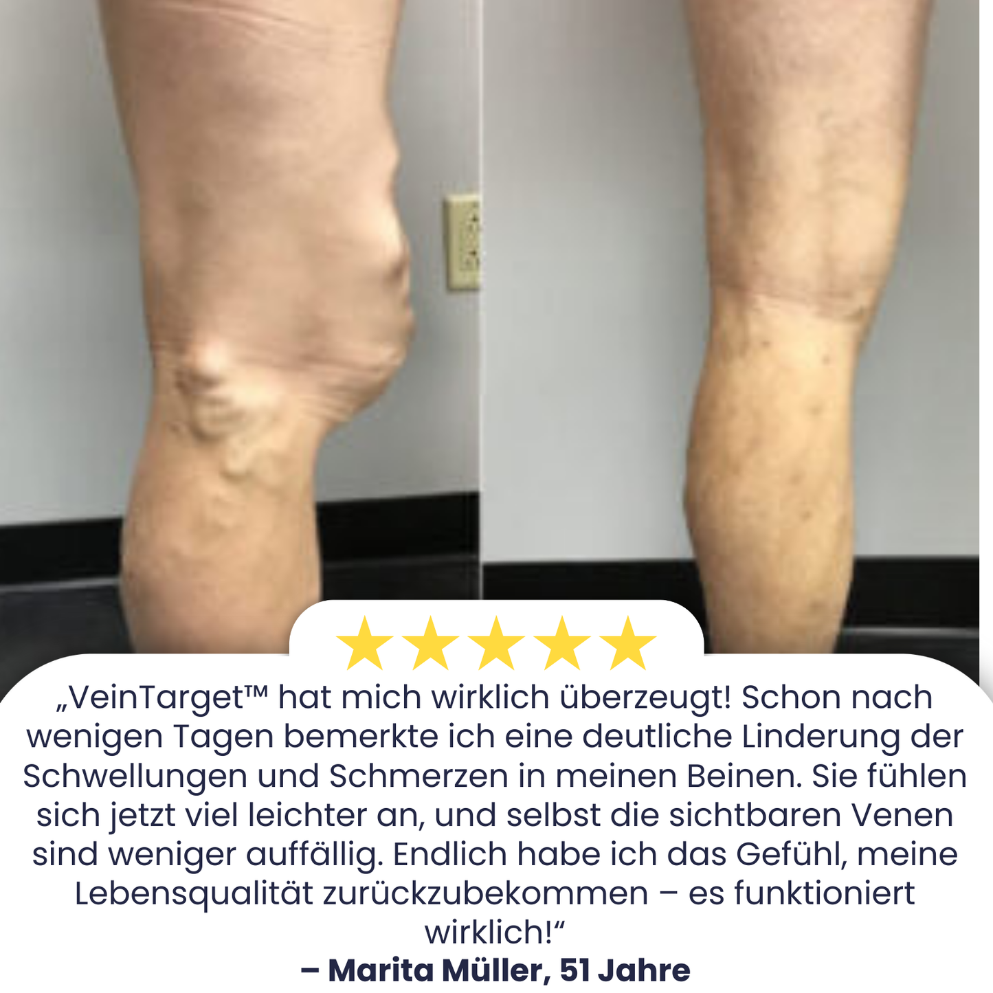 VeinTarget™ | 95 % Linderung – Sichtbare Venenveränderung