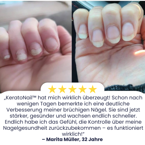 KeratoNaill™ | Verwandeln Sie schwache Nägel!