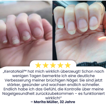 KeratoNaill™ | Verwandeln Sie schwache Nägel!