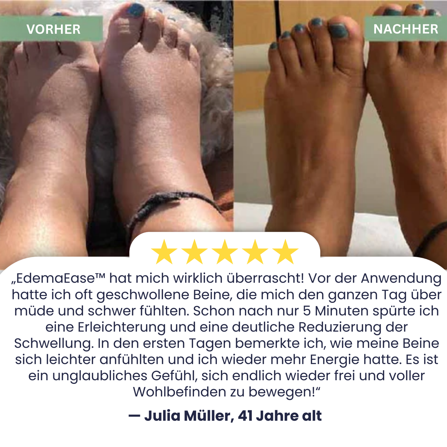 EdemaEase™ | Verabschiede dich noch heute von Schwellungen!