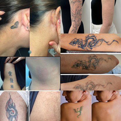 TattWeg™ Sprühflasche | 99% Tattoo Tinte entfernt!
