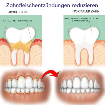 ZahnfleischVital™ | Baut zurückgehendes Zahnfleisch!