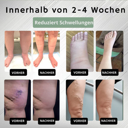 EdemaEase™ | Verabschiede dich noch heute von Schwellungen!