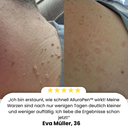 AlluraPen™ | Warzen in 2 Wochen entfernen – 100% Wirksam!